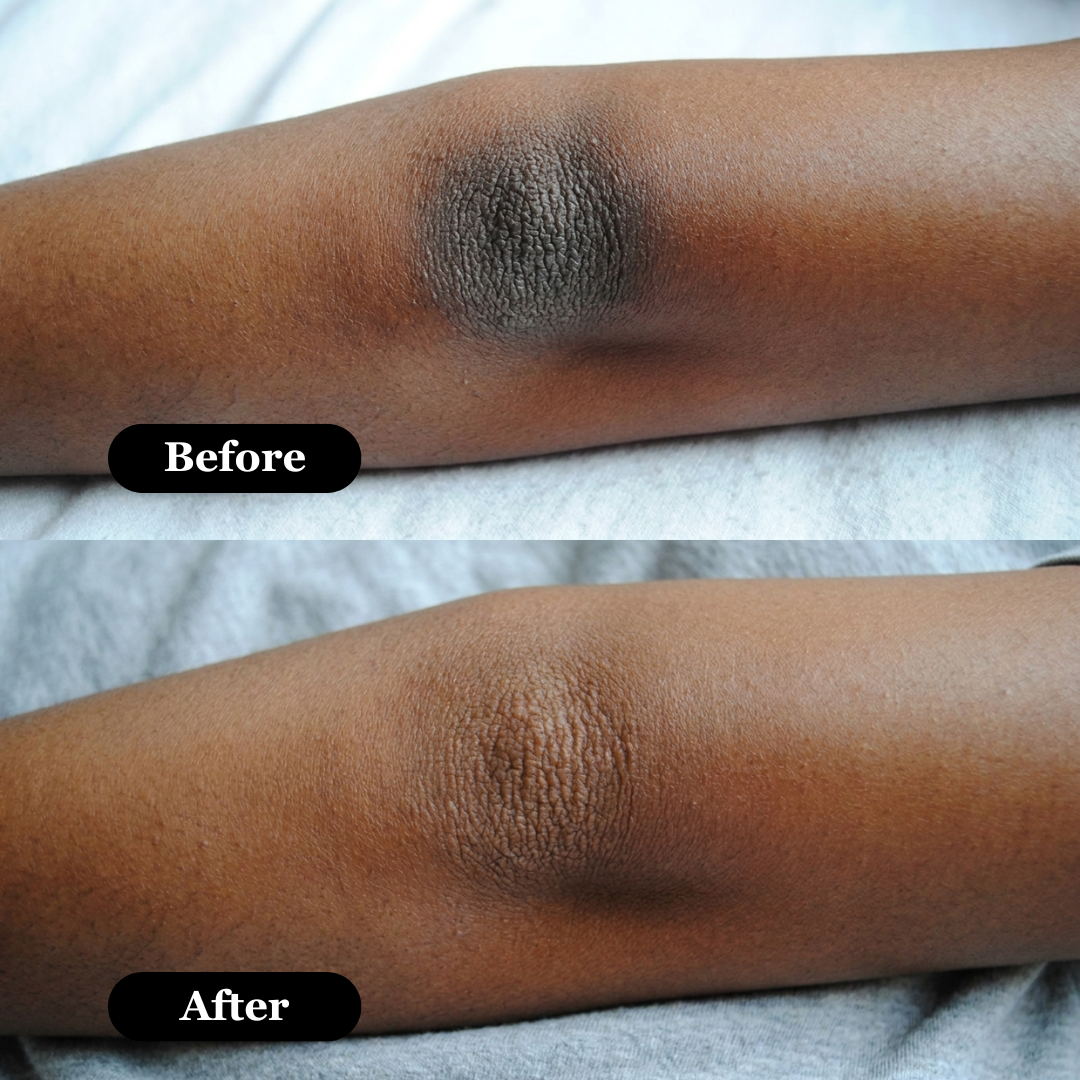 Rova Retinal Skin Booster