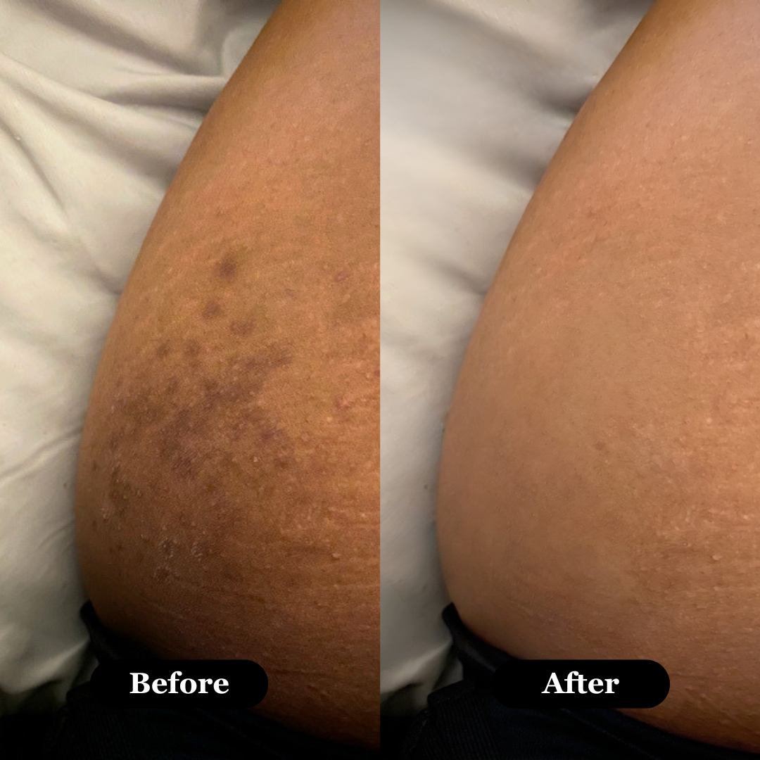 Rova Retinal Skin Booster